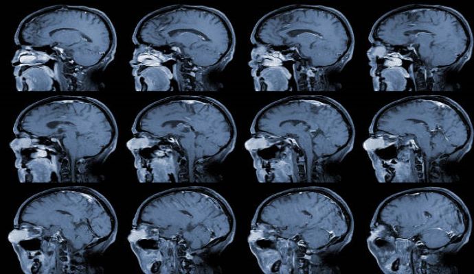 A recent study published in the Lancet Oncology examined the relationship between radiation exposure from CT scans and brain cancer in children and young adults. 